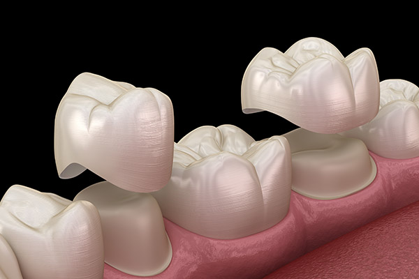 Crown Lengthening Procedure from a Periodontist from Brighton Specialty Dental Group in Ventura, CA