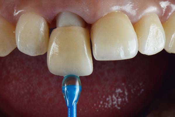 What Materials Are Dental Crowns Made Of?