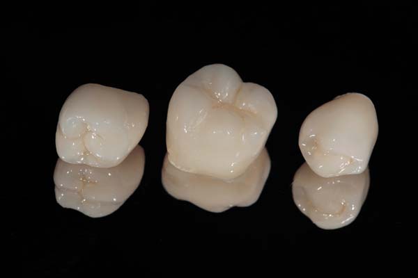 A Dental Crown Overview: What You Need To Know