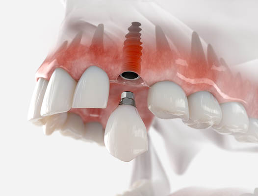 Bone Graft Procedure For Dental Implants