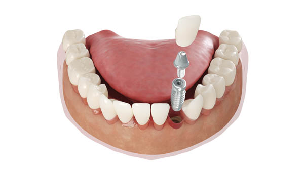Dental Implants Ventura, CA