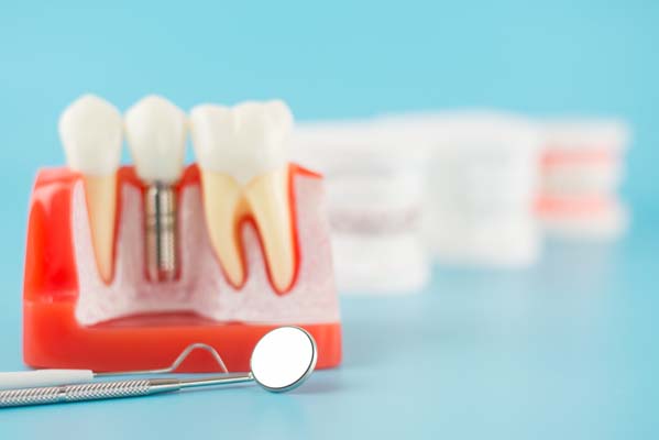 How Dental Implants Are Used With Bridges