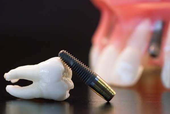 Can You Whiten Tooth Implants?
