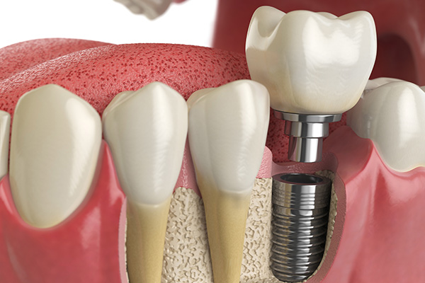 A Periodontist Explains the Bone Graft Procedure for Implants from Brighton Specialty Dental Group in Ventura, CA